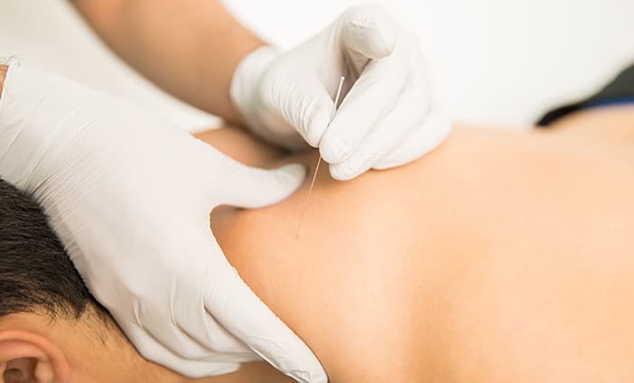 Dry Needling